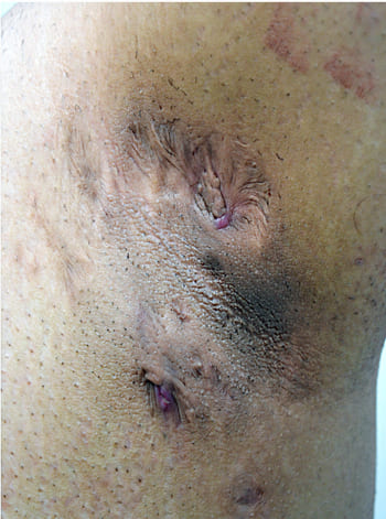 جراحی ضایعات پوستی