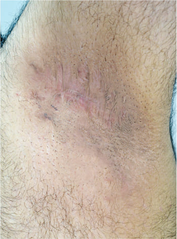 جراحی ضایعات پوستی