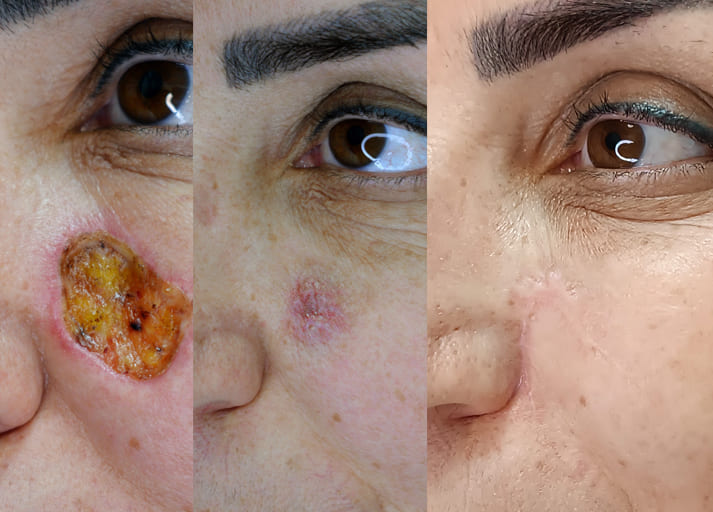 جراحی میکروگرافیک موس