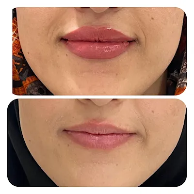 تزریق فیلر
