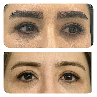 کاشت مو، ریش و ابرو