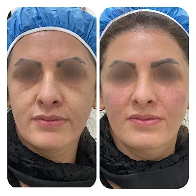 تزریق فیلر