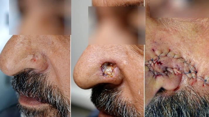 جراحی میکروگرافیک موس