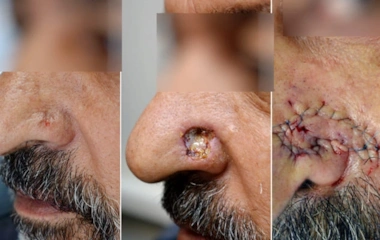 جراحی میکروگرافیک موس