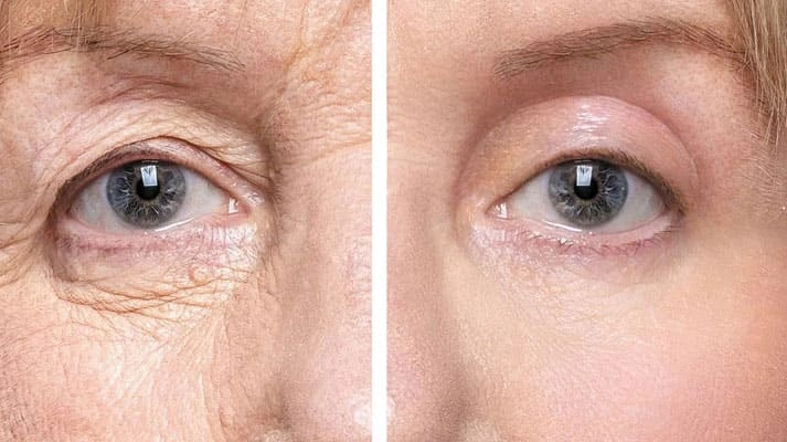 جراحی پلک (بلفاروپلاستی)