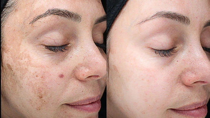 درمان‌های تخصصی لک