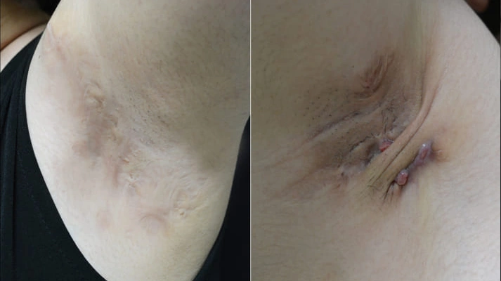 جراحی ضایعات پوستی