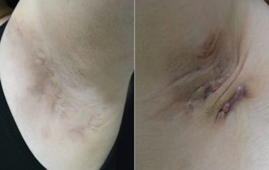 جراحی ضایعات پوستی