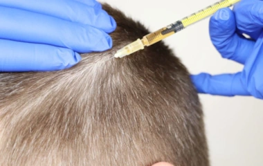 مزوتراپی رشد مو