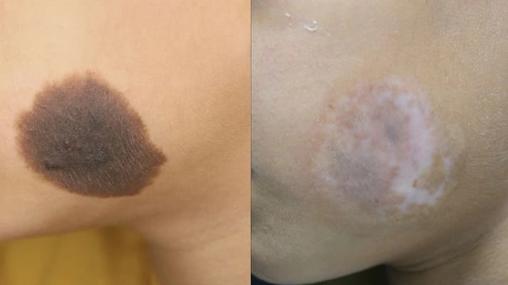 جراحی انواع خال