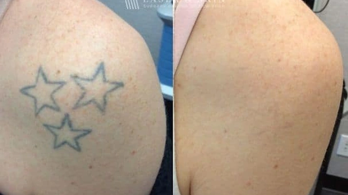 رفع تاتوهای پوستی