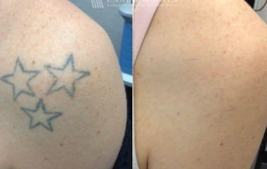 رفع تاتوهای پوستی