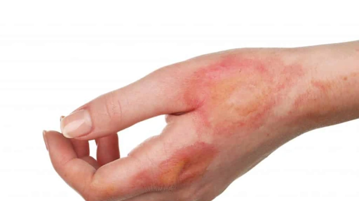 درمان اسکارهای سوختگی، زخم، جای جوش و ...