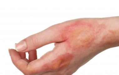 درمان اسکارهای سوختگی، زخم، جای جوش و ...