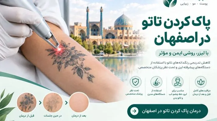 پاک کردن تاتو در اصفهان