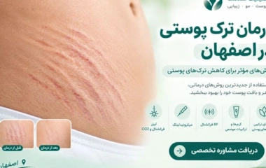 درمان ترک پوستی در اصفهان