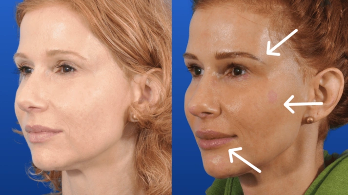 جوانسازی با تزریق چربی 