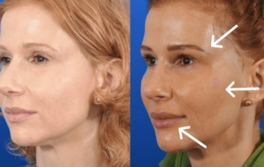 جوانسازی با تزریق چربی