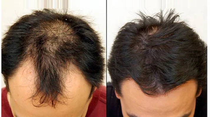 درمان ریزش مو به کمک لیزر