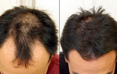 درمان ریزش مو به کمک لیزر