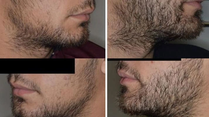 کاشت طبیعی مو ابرو ریش