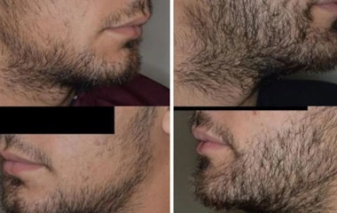 کاشت طبیعی مو ابرو ریش
