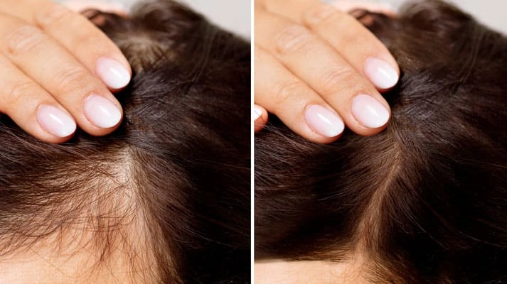 درمان‌های ریزش و تقویت مو