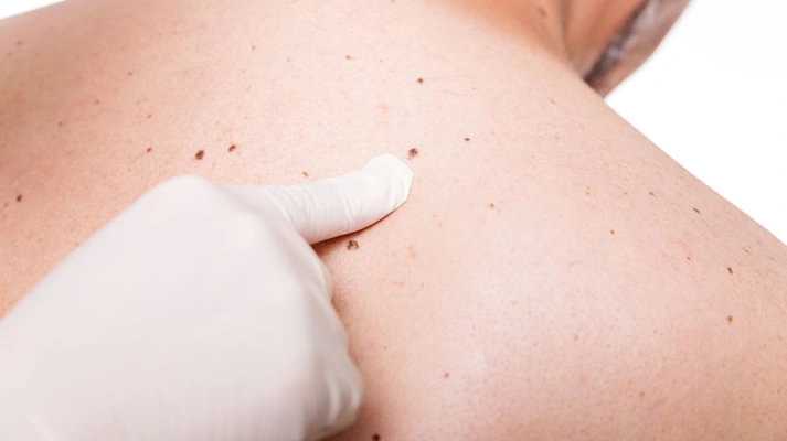 جراحی ضایعات پوستی شامل سرطان های پوست