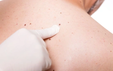 جراحی ضایعات پوستی شامل سرطان های پوست