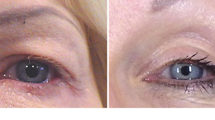 بلفاروپلاستی غیرجراحی