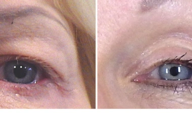 بلفاروپلاستی غیرجراحی